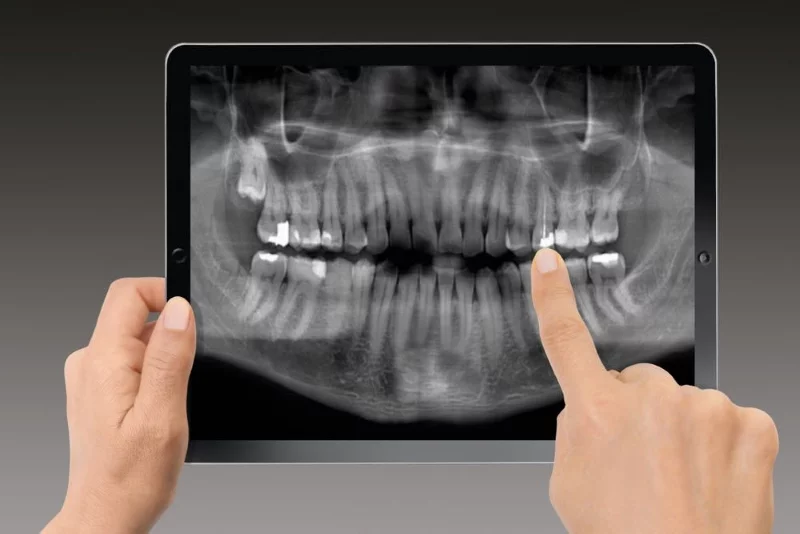 rentgen in vitamin D - Clarus dentalni center